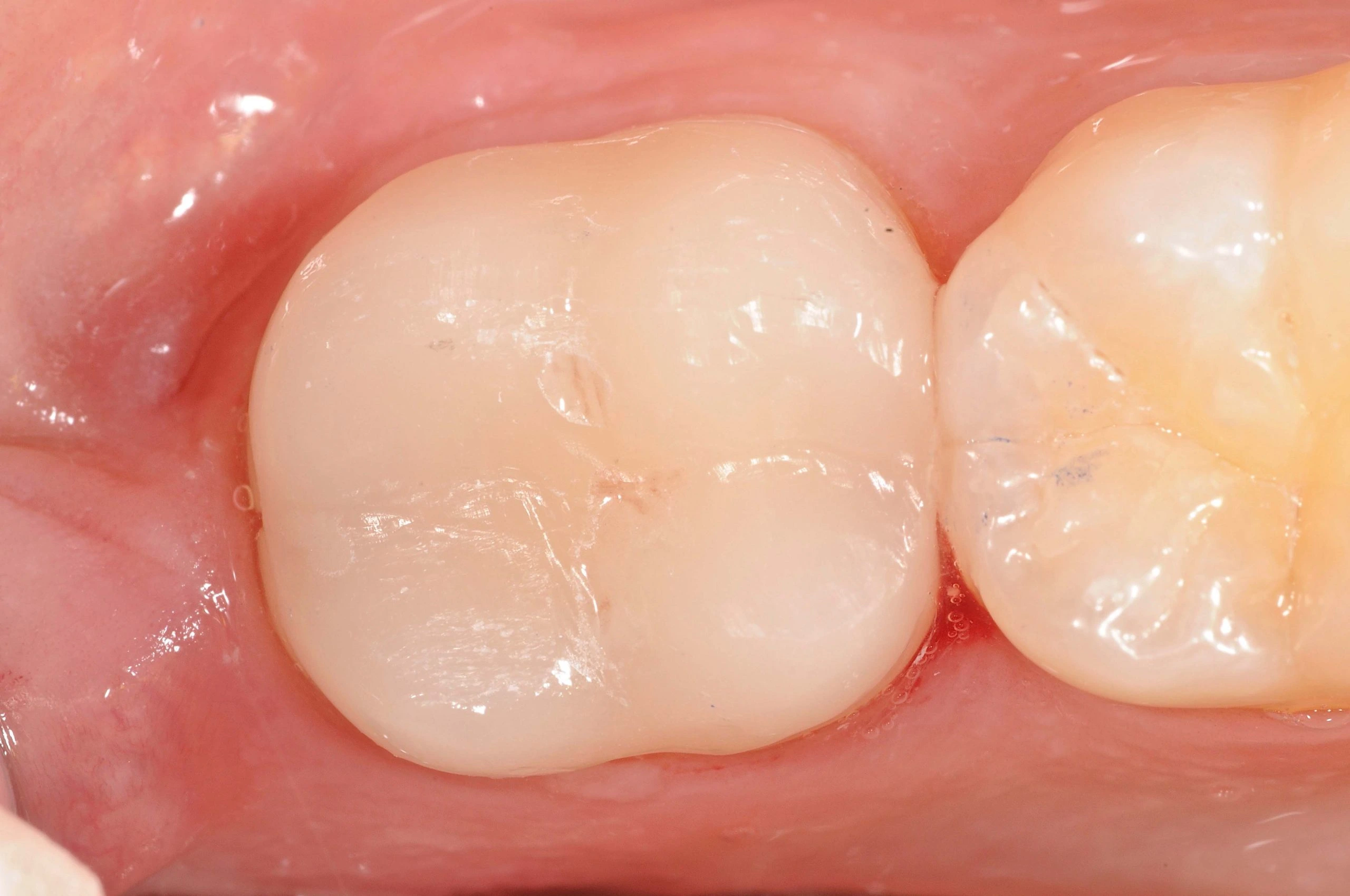 Cerec Crowns