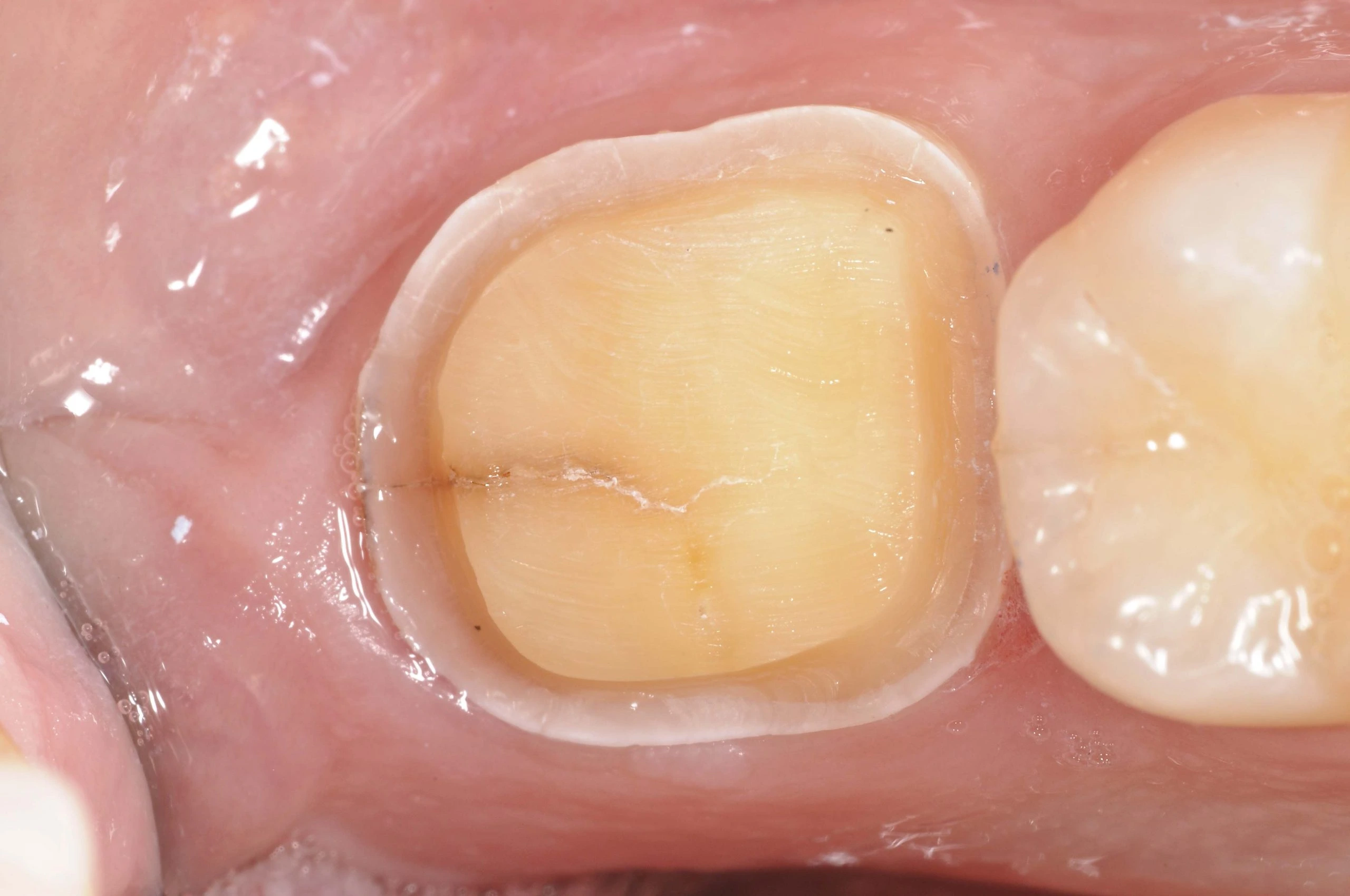 Cerec Crowns